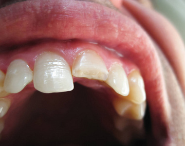 男子向牙医展示口腔.断牙的治疗照片