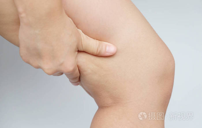 女性腿大腿与脂肪团.