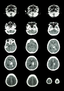 出血性脑卒。Ct 扫描 计算机断层扫描 的大脑 c