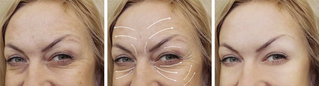 面对男人的皱纹前后图片