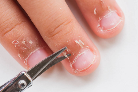 闭上妈妈用剪刀剪干皮肤的孩子的手指, 湿疹皮炎.医疗保健理念照片