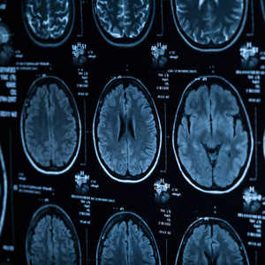 人脑的医学 x 射线, 特写图像