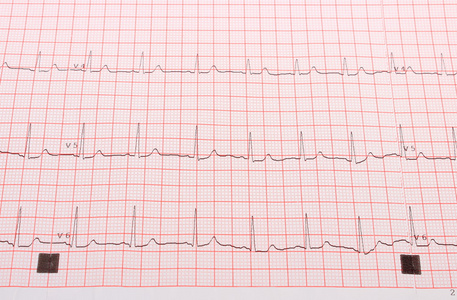 心电图上的粉红色的网格