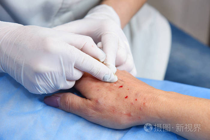 注射自體血清的目的是什么__自體血清注射死亡案例