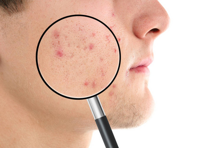 男性皮肤问题图片