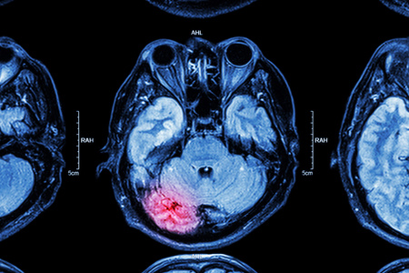 脑 Mri 脑损伤