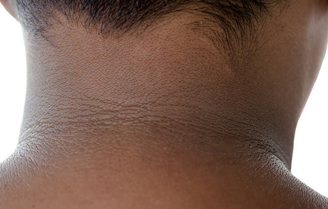 紫外线晒伤晒伤的脖子照片