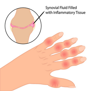 手指类风湿关节炎医学向量例证图片