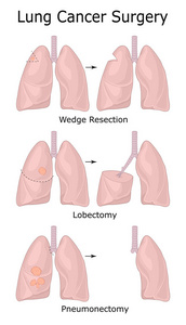 不同类型肺癌手术的例证