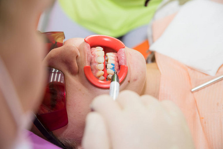 确定牙齿的色调。女性患者在诊所看牙医进行牙齿美白, 牙齿美白程序。美白系统