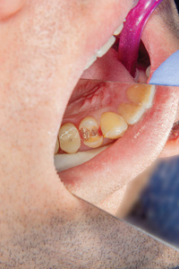 龋齿。使用 rabbders 填充牙科复合感光树脂材料。牙科诊所的牙科治疗理念