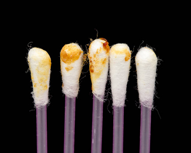 棉签采耳棉签上的耳蜡, 耵聍照片