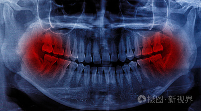 人类牙齿的x线扫描