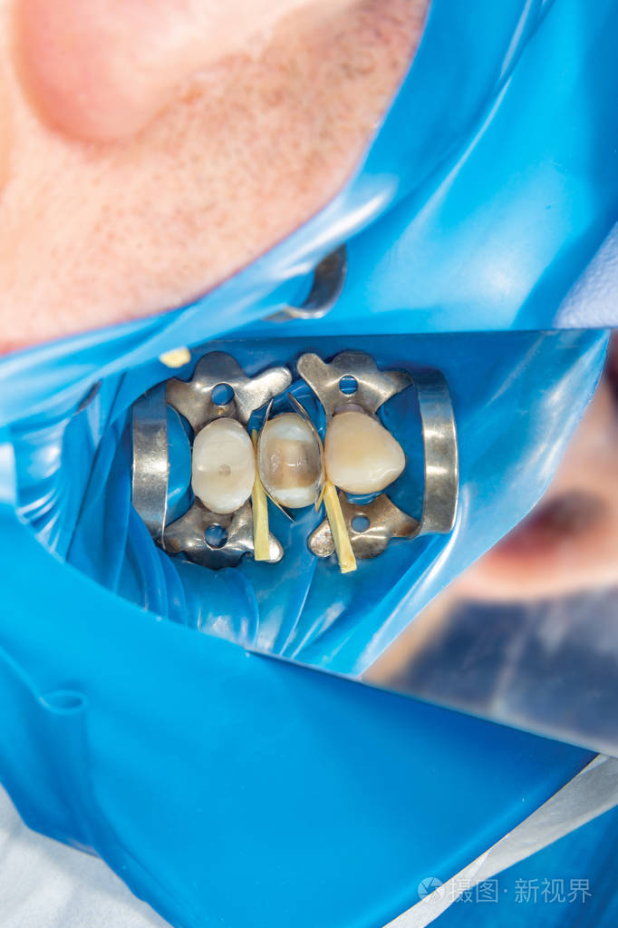 龋齿使用rabbders填充牙科复合感光树脂材料牙科诊所的牙科治疗理念