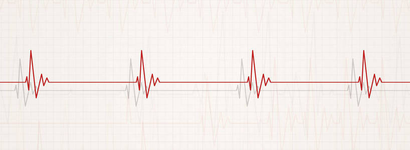 说明胸病的医学横幅。心率小于每分钟60次