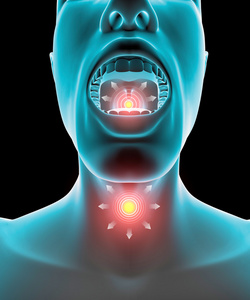 喉咙发炎, 疼痛, 红肿照片