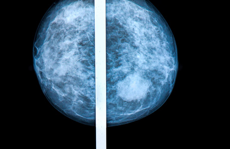 钼靶乳腺扫描 x 射线
