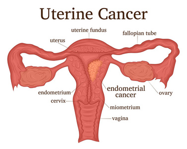 女性生殖系统疾病子宫癌的例证