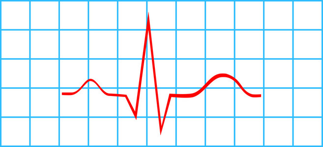 心电图心电图图片