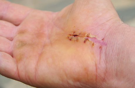 桡管综合征图片