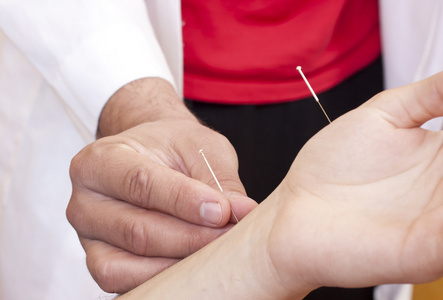 中医针灸图片