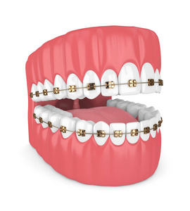 3d. 在白色背景下, 用牙齿和金色正畸大括号渲染下巴