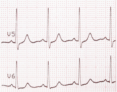 心电图 心电打印输出 心电图背景