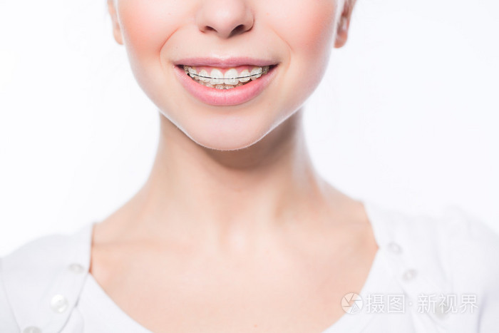 牙齿大括号的女人