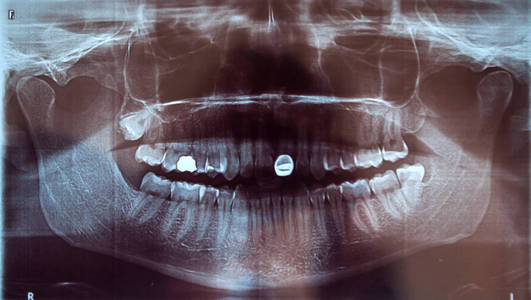 牙齿 x 光牙智齿问题牙科医学