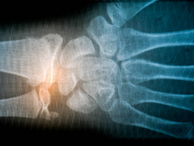 x 射线胶片骨架人体手臂。健康医学解剖学身体概念