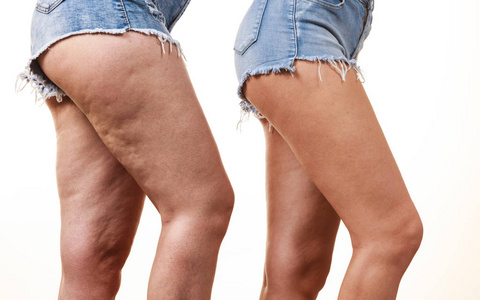 身体松弛对比女性双腿大腿和无脂肪的比较.