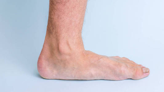 有关节疾病和扁平脚症状的人的左腿。腿部和关节疾病