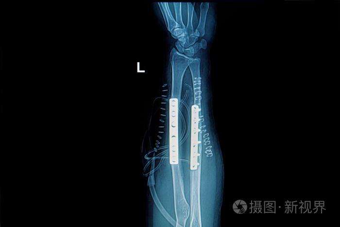 前臂植入物板和螺钉的X线图像