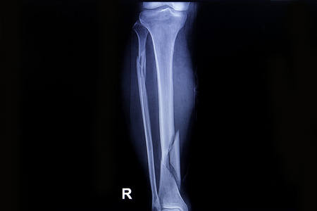 腿部骨折x 射线图像显示骨折两腿部的骨头一根照片