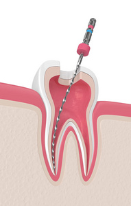 3d. 在牙龈中用根管文件进行牙齿渲染。根管治疗概念