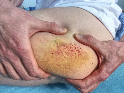 男性身体的细节.人皮肤疼痛皮下损伤照片