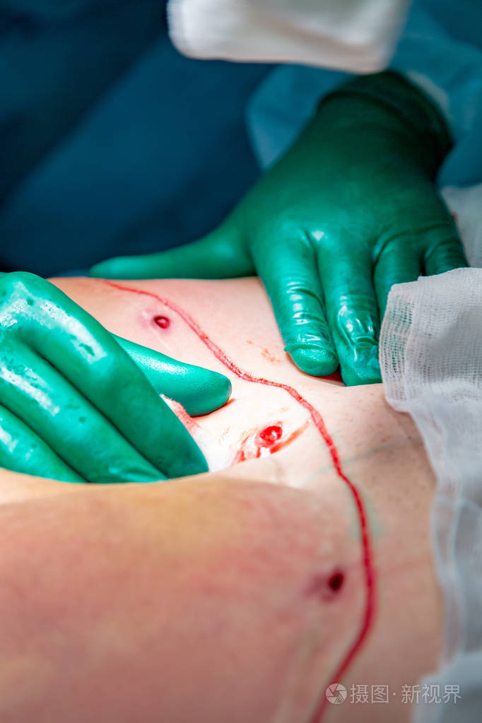 外科手术腹部.腹部脂肪组织的手术切除