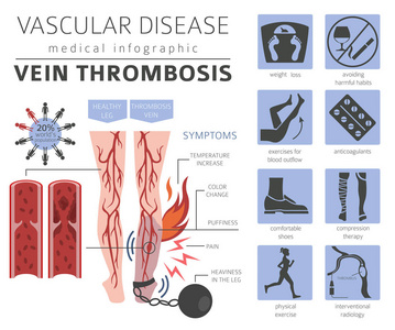 血管疾病。静脉血栓形成症状, 治疗图标设置。医疗图表设计。矢量插图