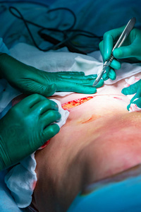 腹部脂肪组织的手术切除照片