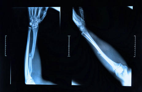 手腕骨裂x光图片图片