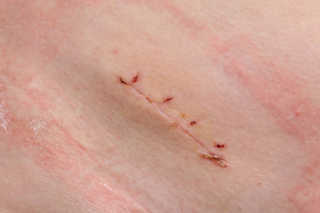 恐怖切手术新鲜阑尾手术疤痕阑尾切除术照片