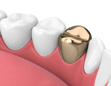 3d. 在白色背景下用金色牙齿冠的牙齿在牙龈上的渲染