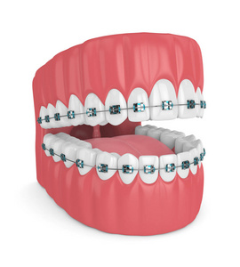 3d. 在白色背景下, 用牙齿和正畸大括号将颚体渲染