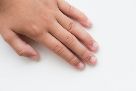 用干皮肤湿疹皮炎把孩子的手指闭上。医疗保健理念