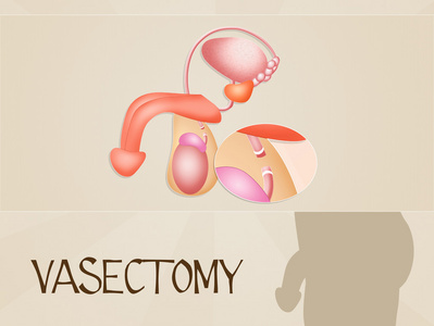 输精管结扎术