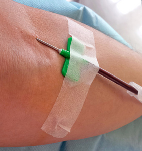 血浆置换在献血过程中针入血献血者的手臂照片