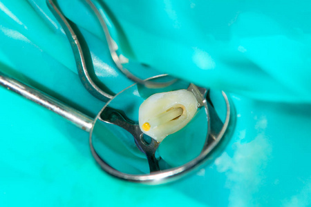 牙管在下磨牙恒牙磨牙中的应用与先端定位器的牙髓锉, 用围堰附着在其上的牙齿