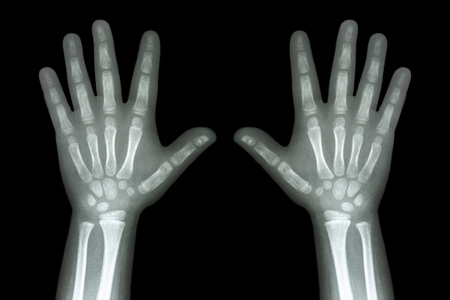 数字方阵x 射线在黑色背景上的这两个孩子手照片