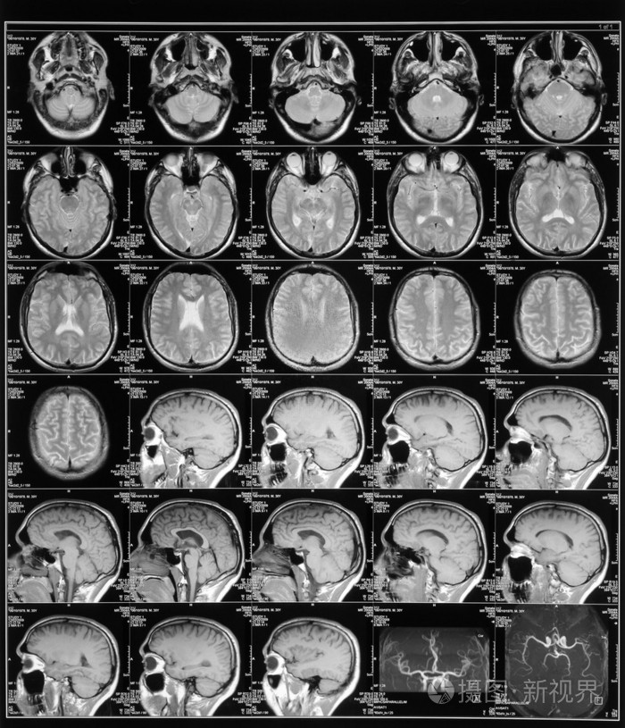 头部磁共振图像