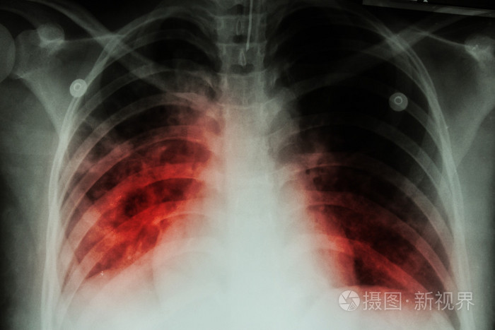 肺结核 Tb 胸部x 光显示肺泡浸润在结核分枝杆菌肺结核infectionpulmonary 结核 Tb 由于两肺 照片 正版商用图片0bdfqk 摄图新视界